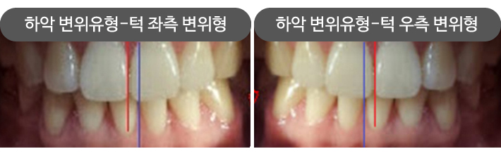 치아 중심선과 입을 벌릴 때 나타나는 아래턱의 편위를 확인하는 사진