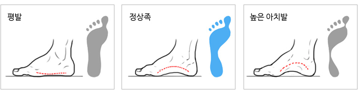 체중 부하에 따른 발 아치의 차이를 설명하는 그림