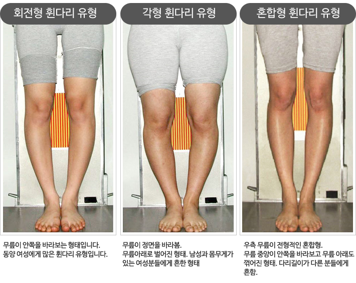 회전형·각형·혼합형 다리 정렬의 특징을 비교한 사진