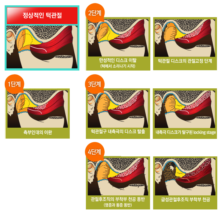 정상 턱관절과 관절원판 위치 변화를 설명하는 해부 그림