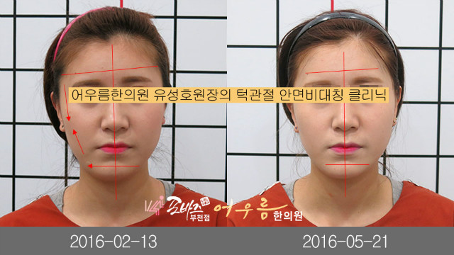 김수연 전후사진1.jpg