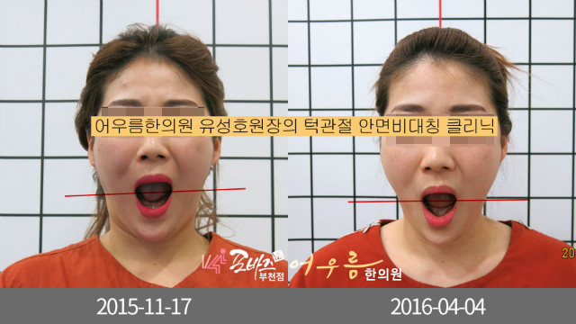 lym02.jpg