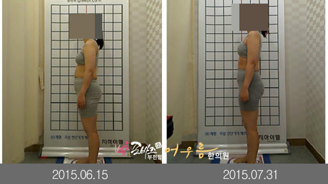 골반교정전후.jpg